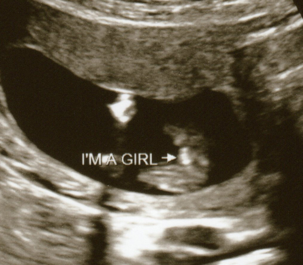 Confirmed girl, nub shots from 11 & 12 weeks, potty shots from 13 & 15 weeks