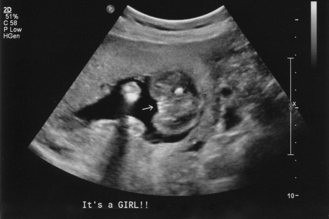 Confirmed girl potty shots at 20 and 25 weeks