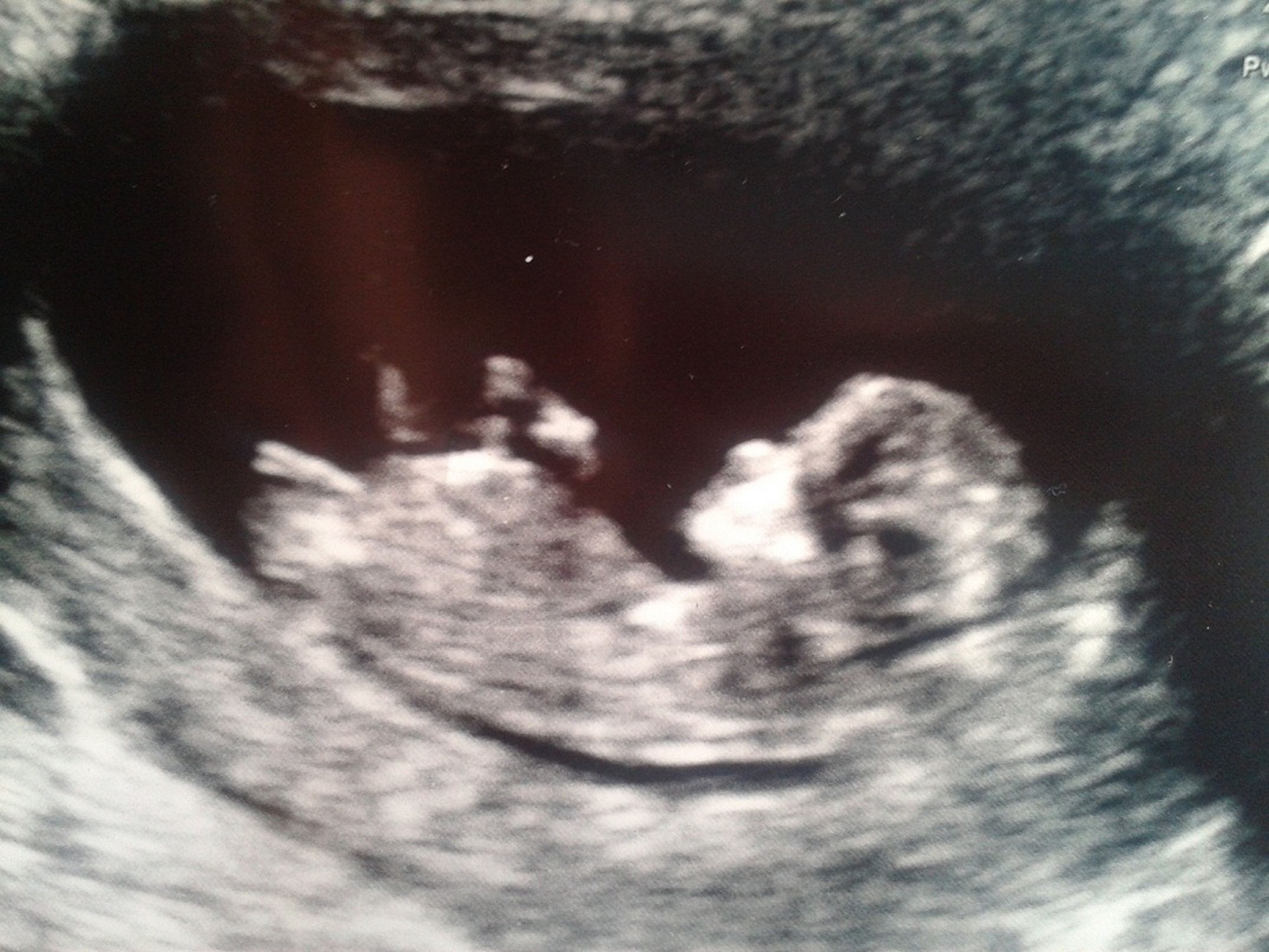 12 weeks nub and 17+3 potty shot ALL GIRL )