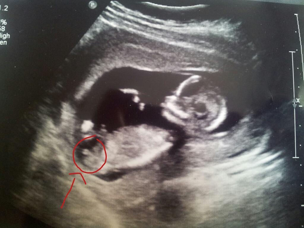 ultrasound-13-weeks-images