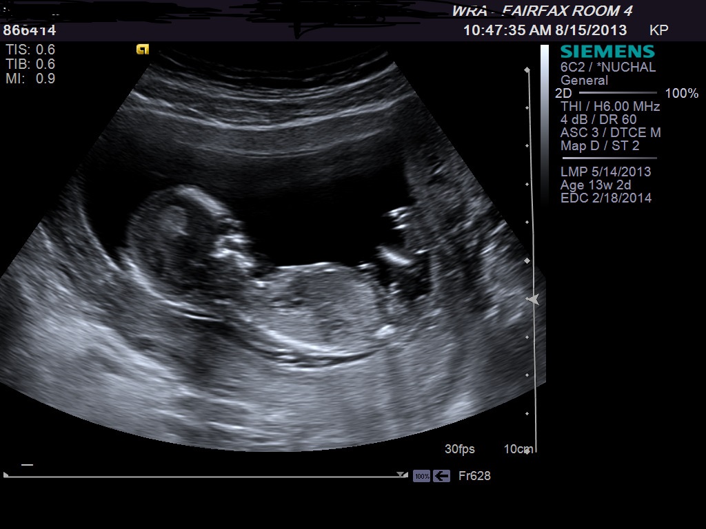 Baby Boy Ultrasound Pics At 13 Weeks - impremedia.net