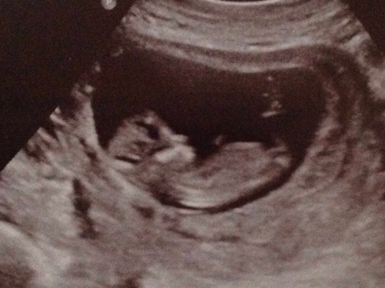 12 and 20 week scan with potty shot, boy or girl?
