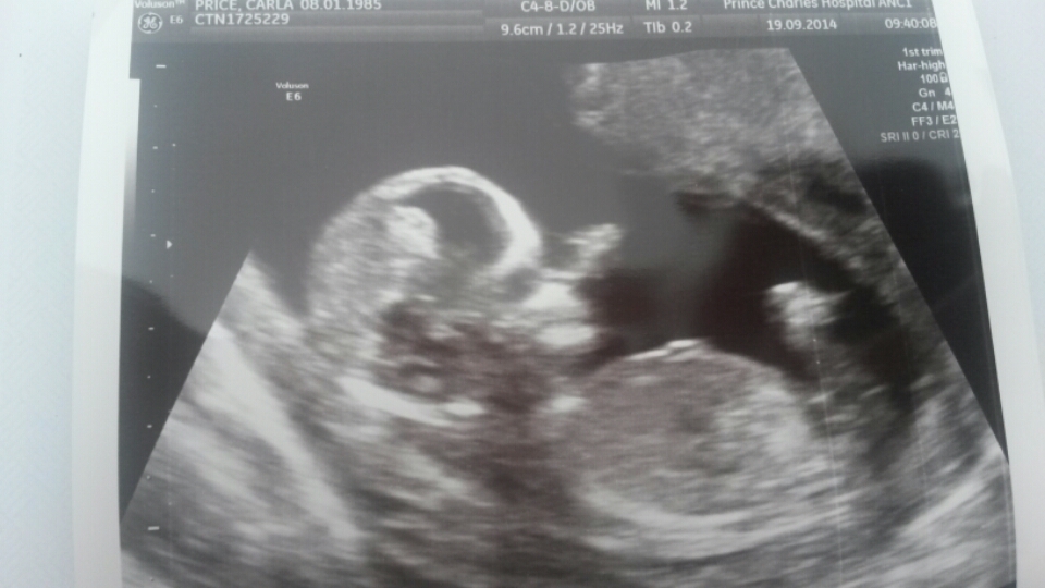 Any gender clues? Nub, skull and 20 week scan