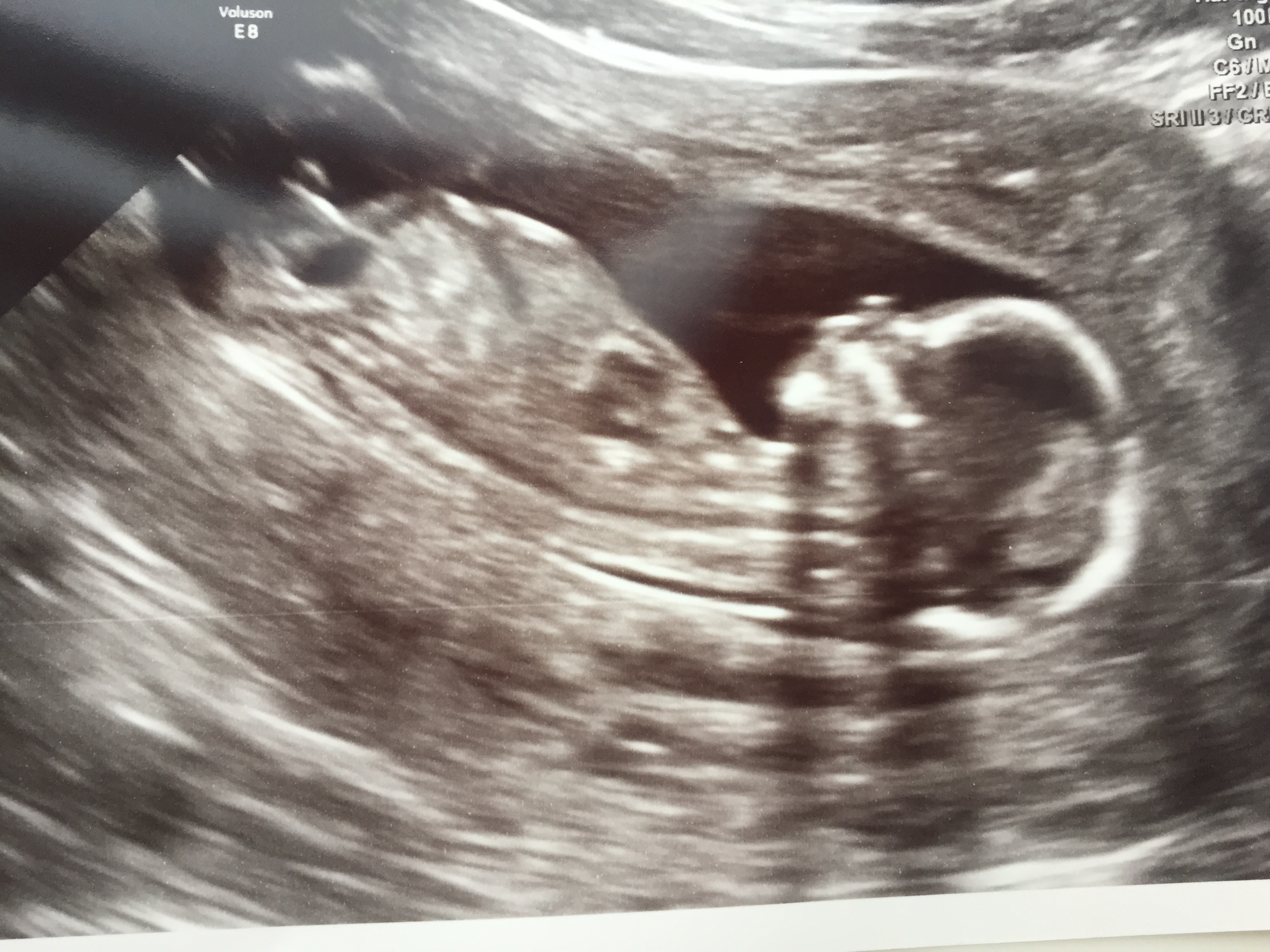 Potty shot Boy or Girl? 14 weeks, 1 day