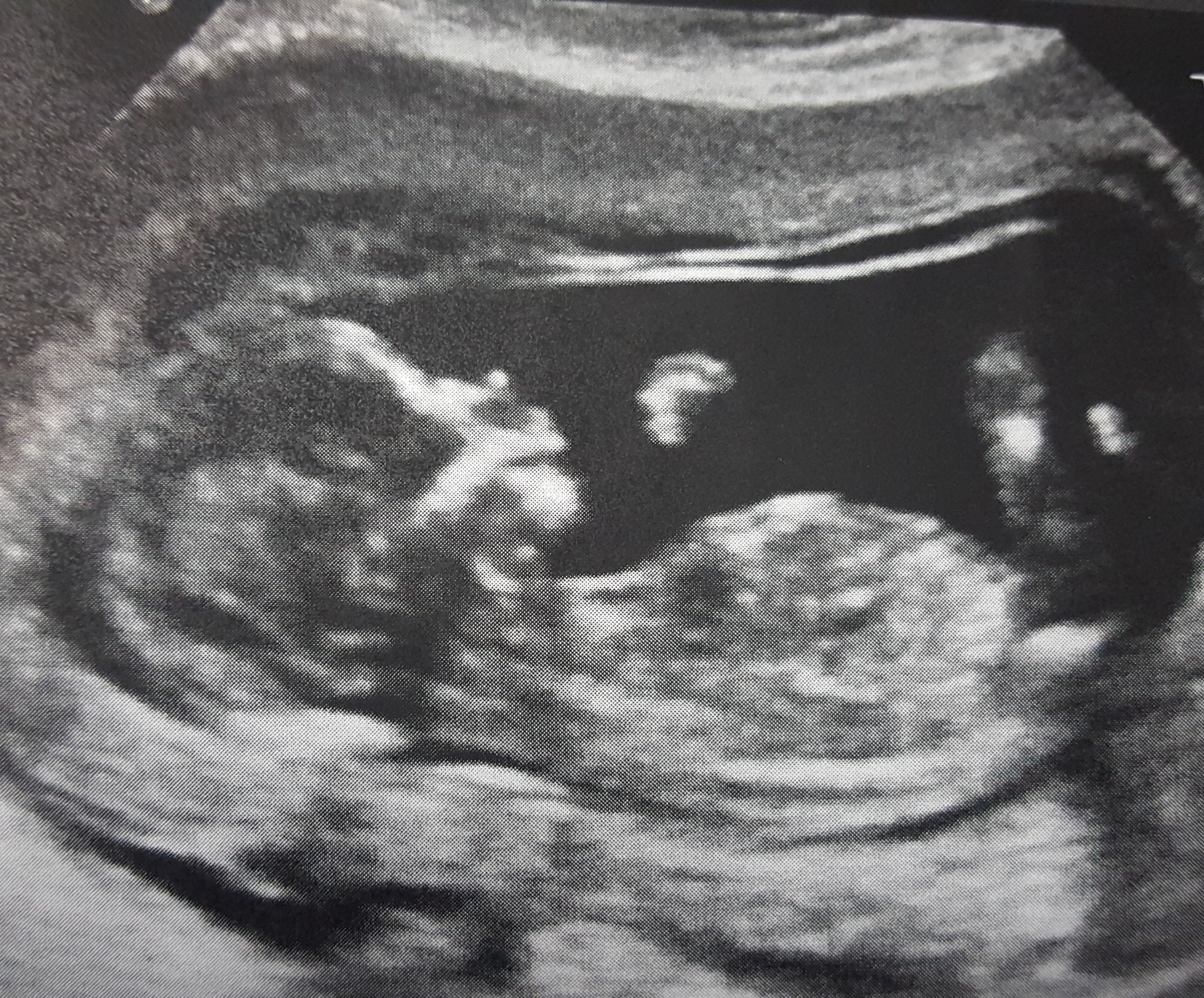 Ultrasound Images At 13 Weeks Pregnant