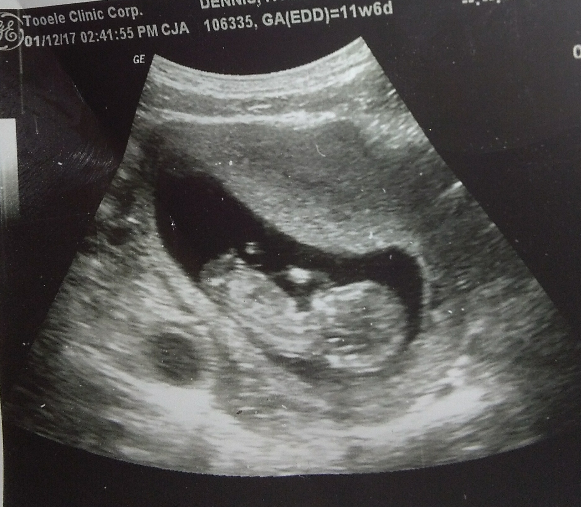 11 Weeks 6 Days, boy or girl based on pictures?