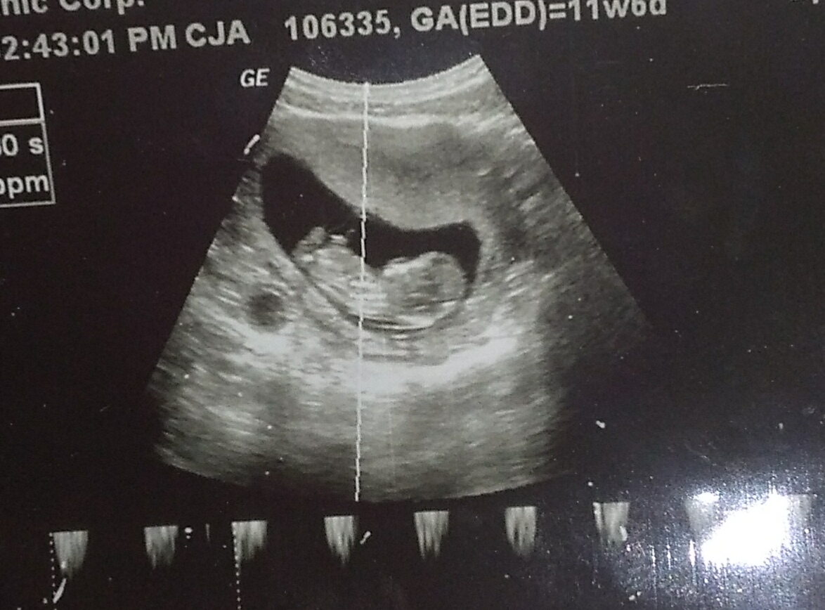 11 Weeks 6 Days, boy or girl based on pictures?