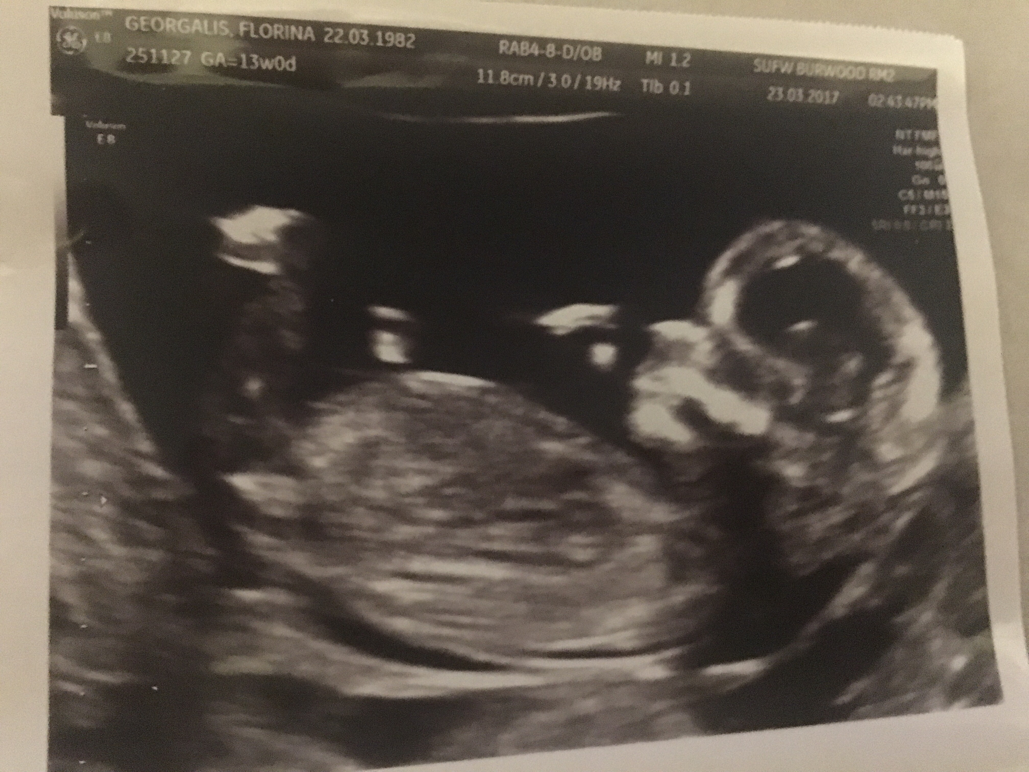 Boy or girl? 13 weeks ultrasound