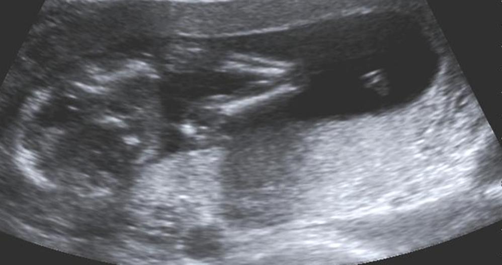 Potty shot ultrasound image at 14 weeks 4 days Boy or Girl?