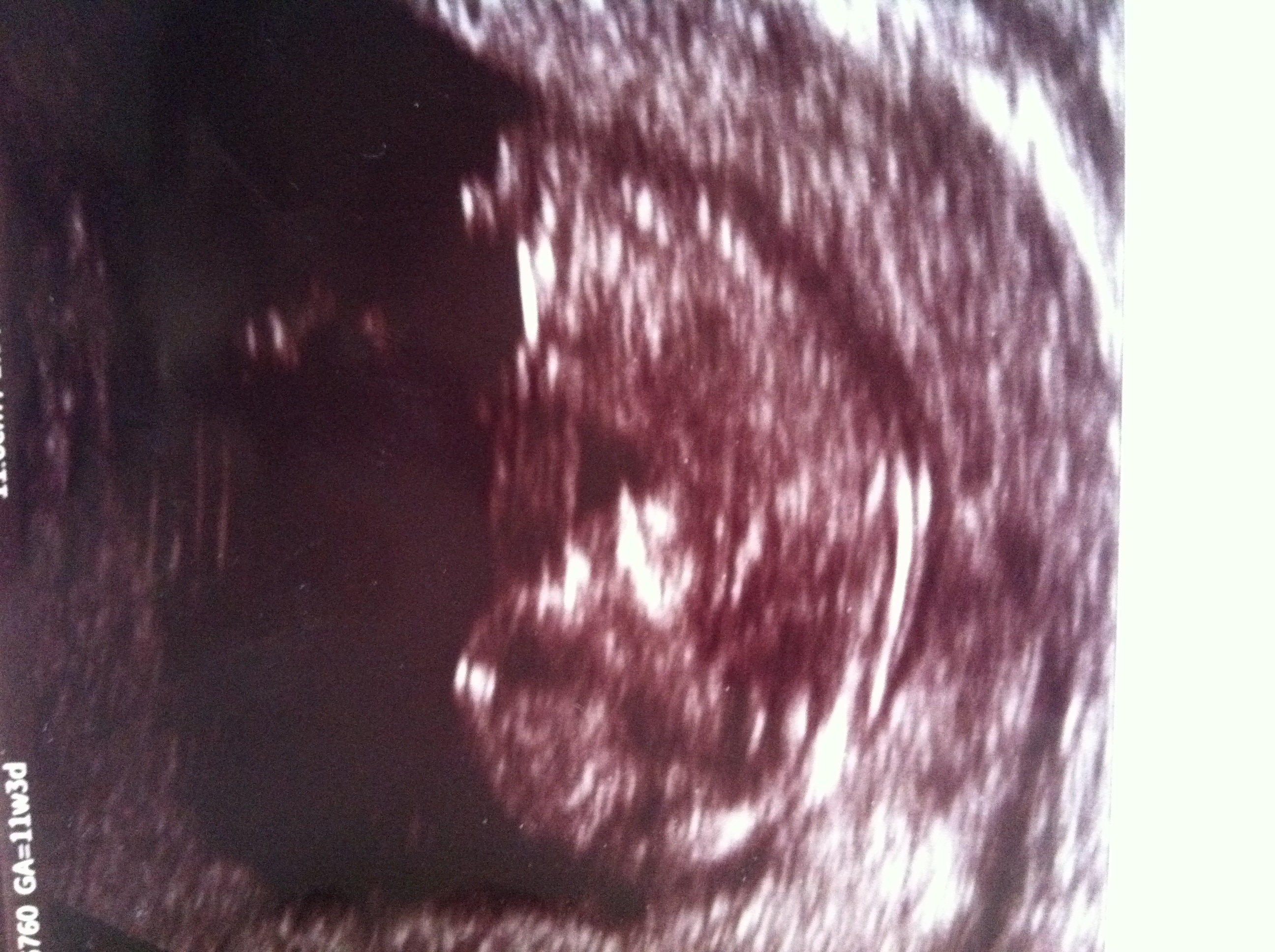 11w3d nt scan, fork on nub is pointing much differently than all the rest I've seen.