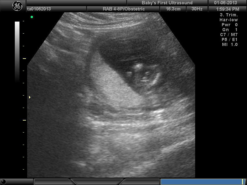 3 dots at 14 weeks